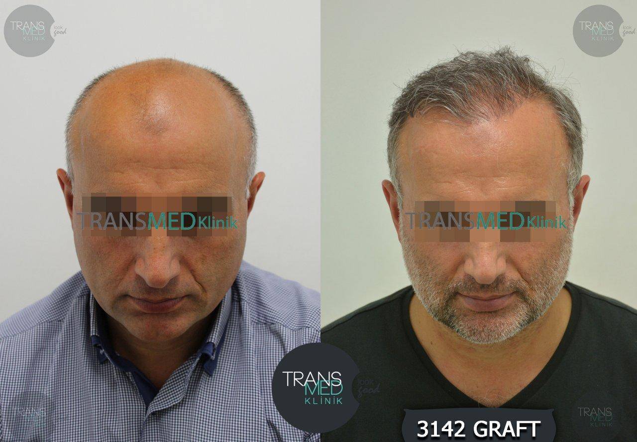 FUE — Transmed Hair Clinic