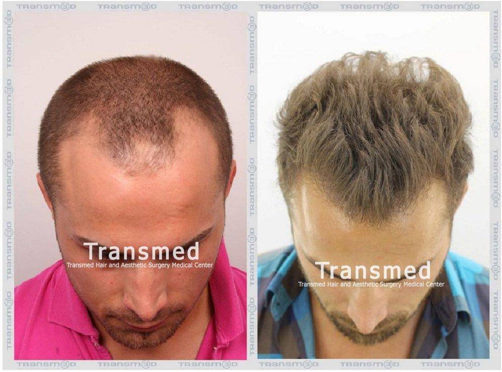 FUE — Transmed Hair Clinic