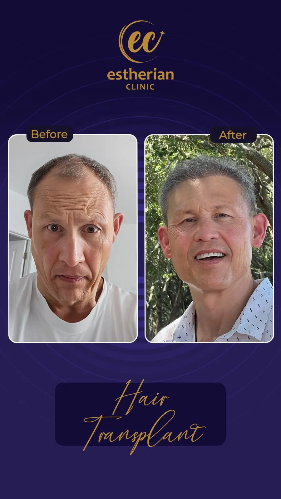 FUE — Estherian clinic