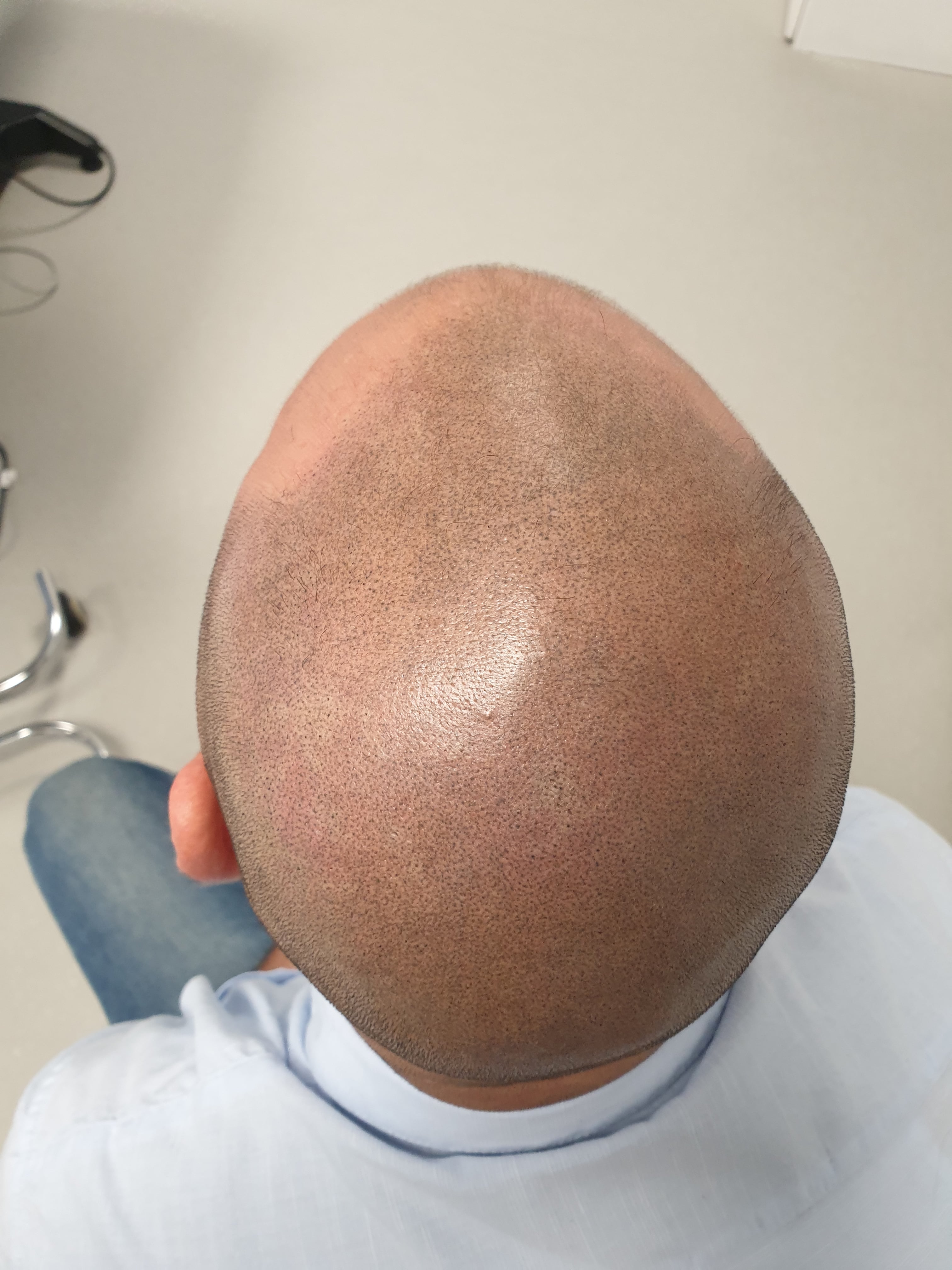 Scalp Micro Pigmentation SMP — Scalp Esthetik