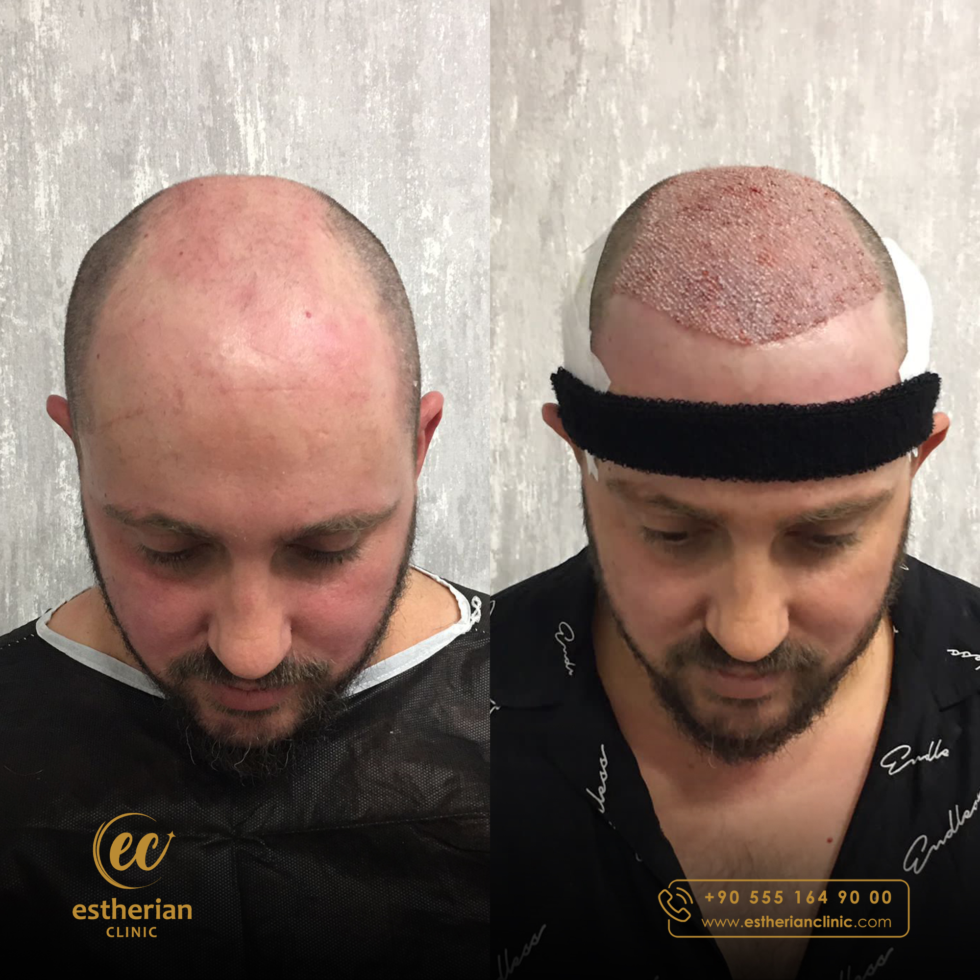 FUE Sapphire — Estherian clinic