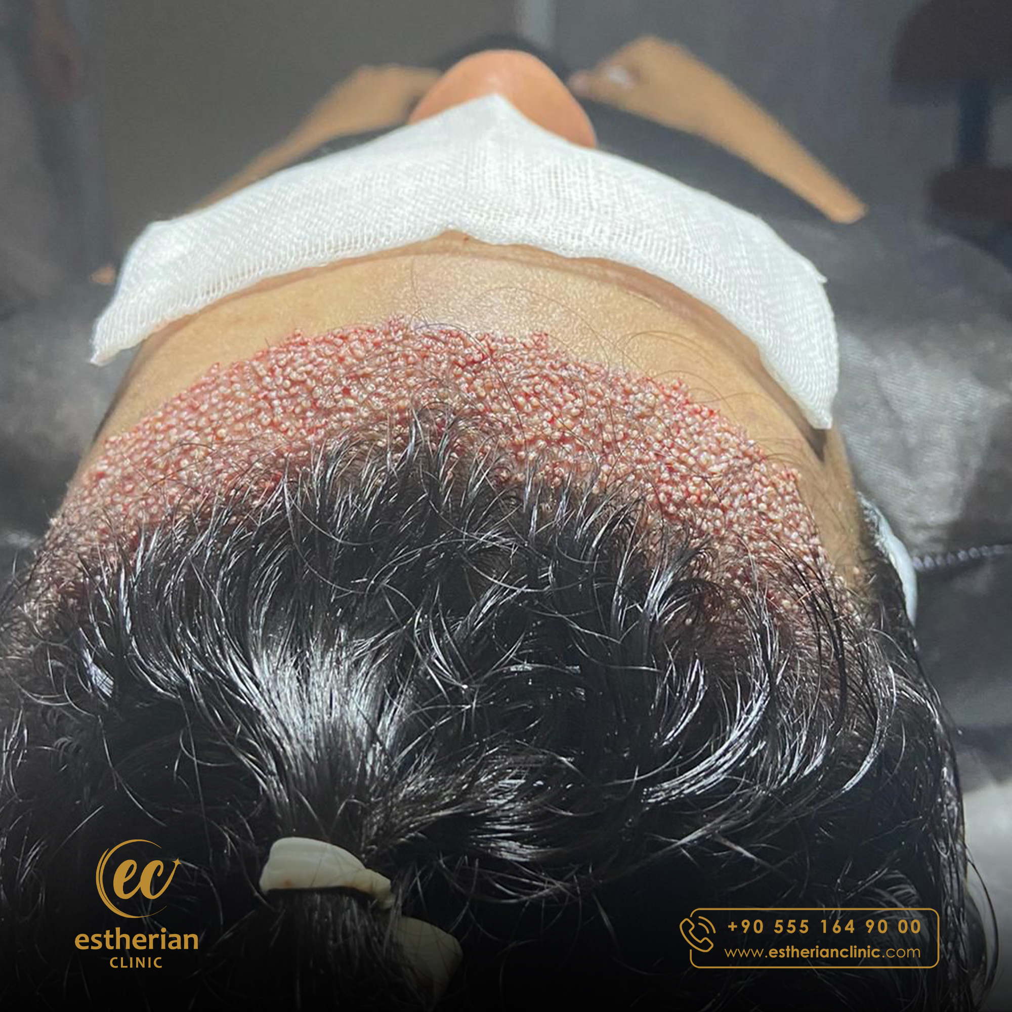 FUE Sapphire — Estherian clinic