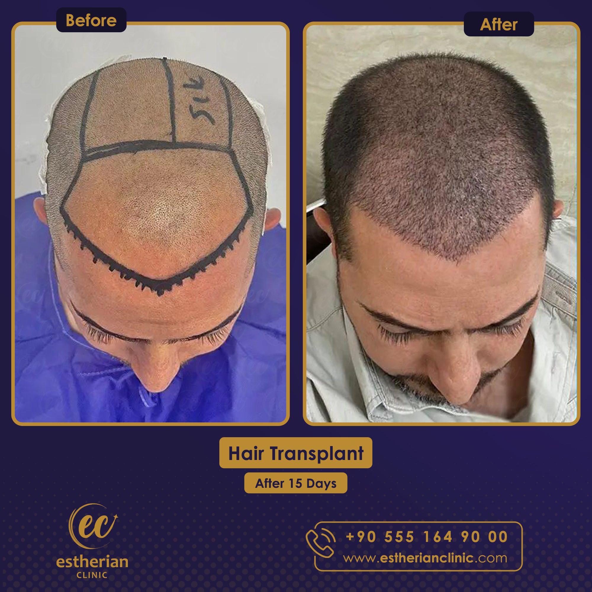 FUE Sapphire — Estherian clinic