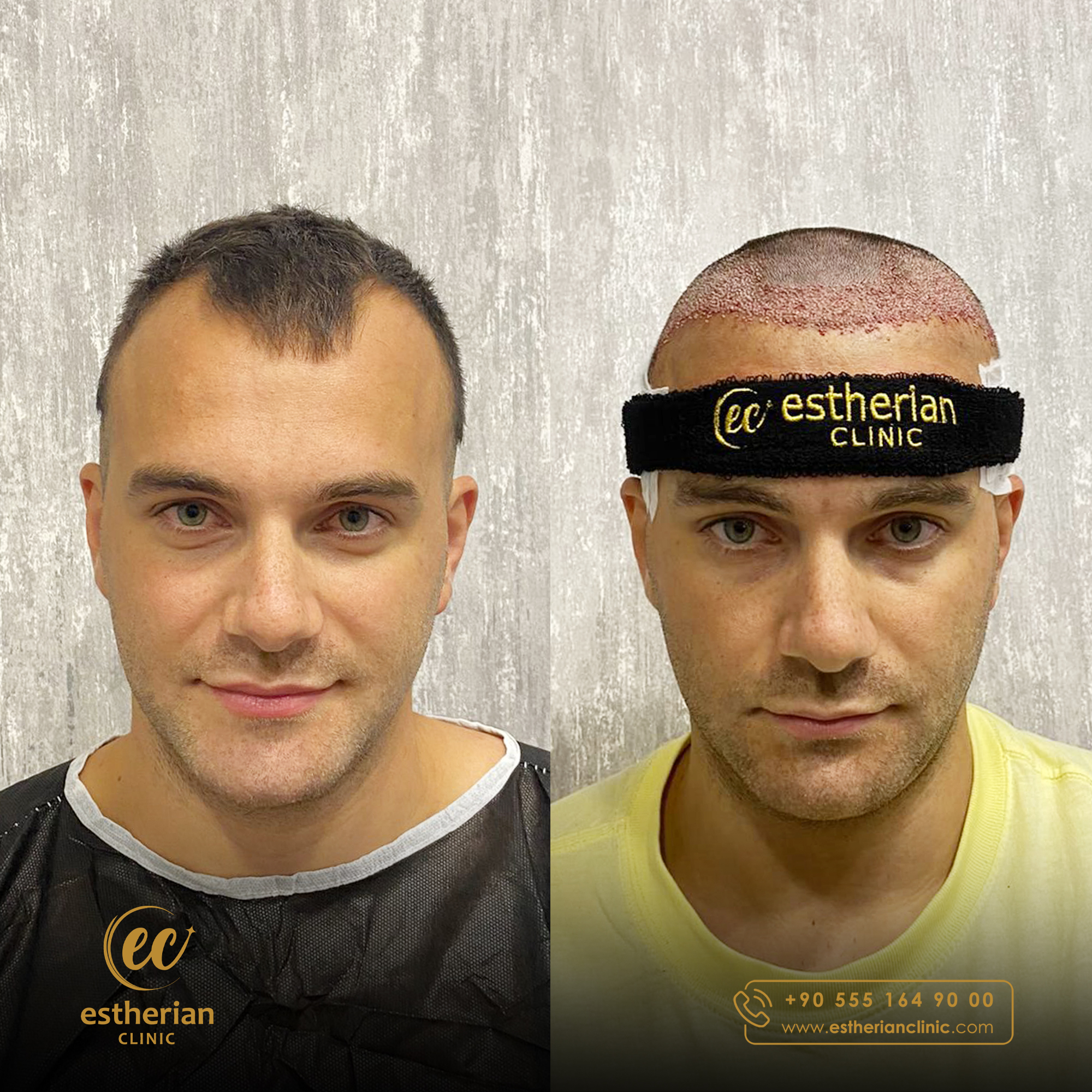 FUE Sapphire — Estherian clinic