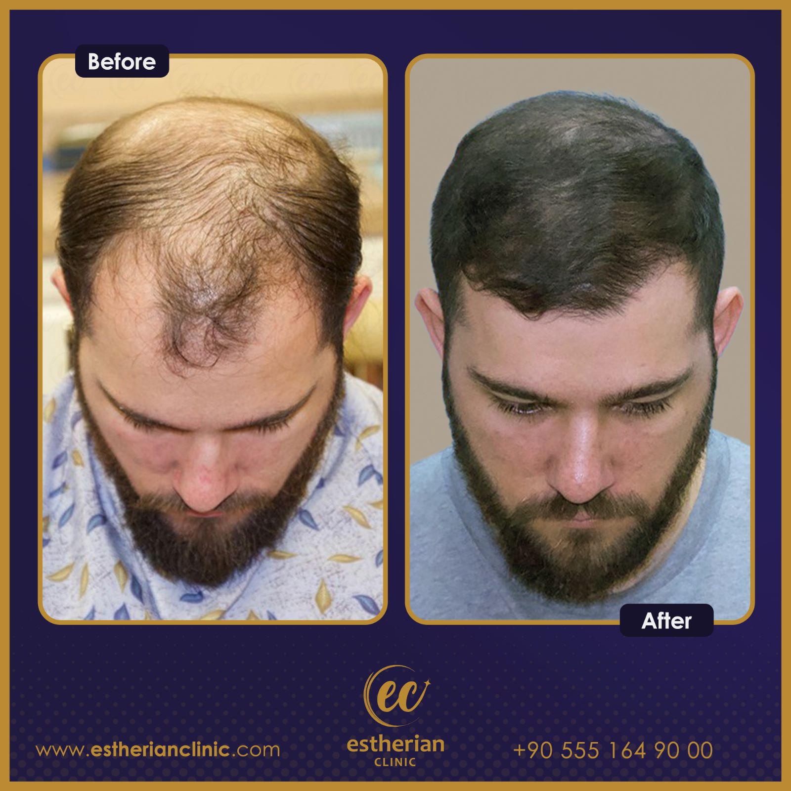FUE Sapphire — Estherian clinic
