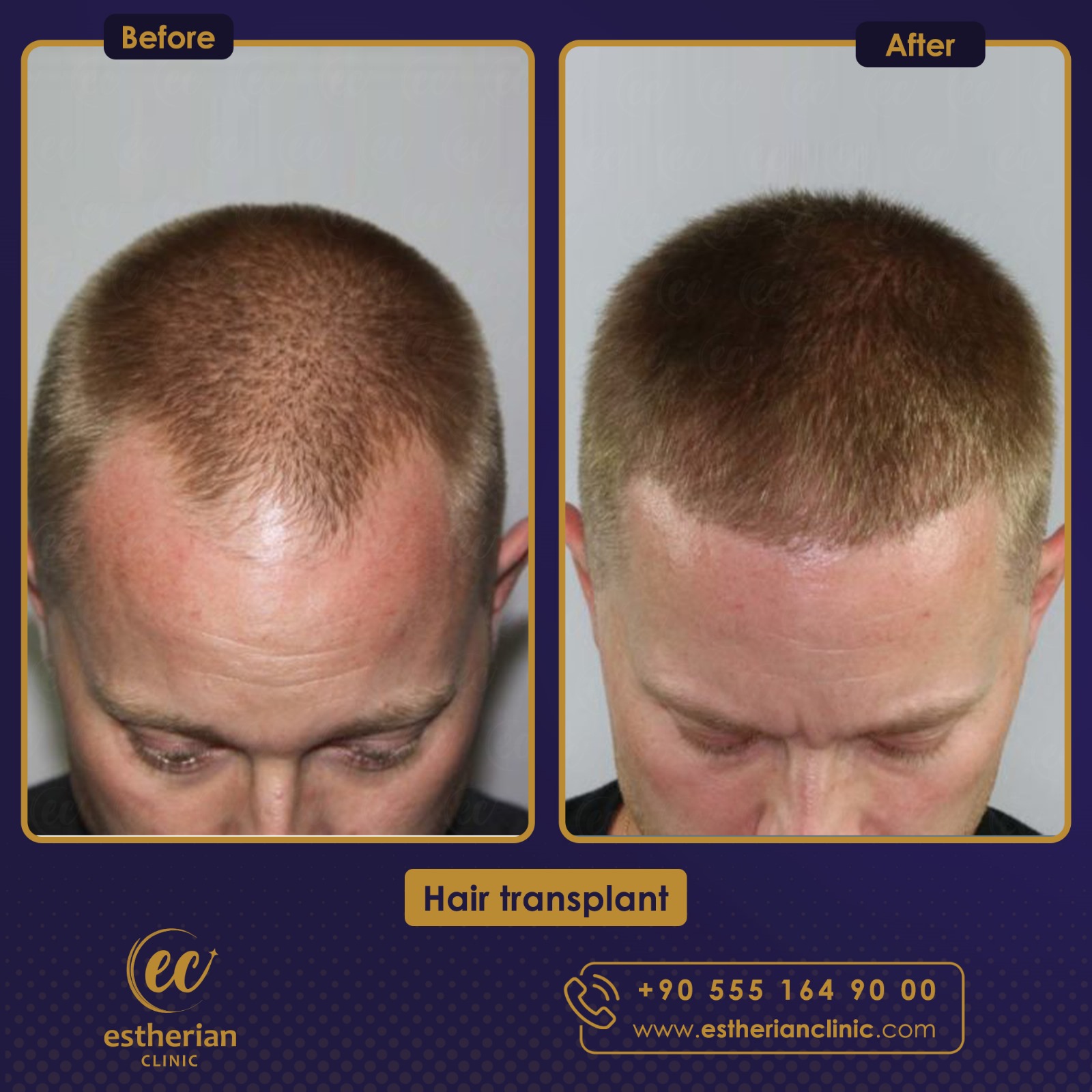 FUE Sapphire — Estherian clinic