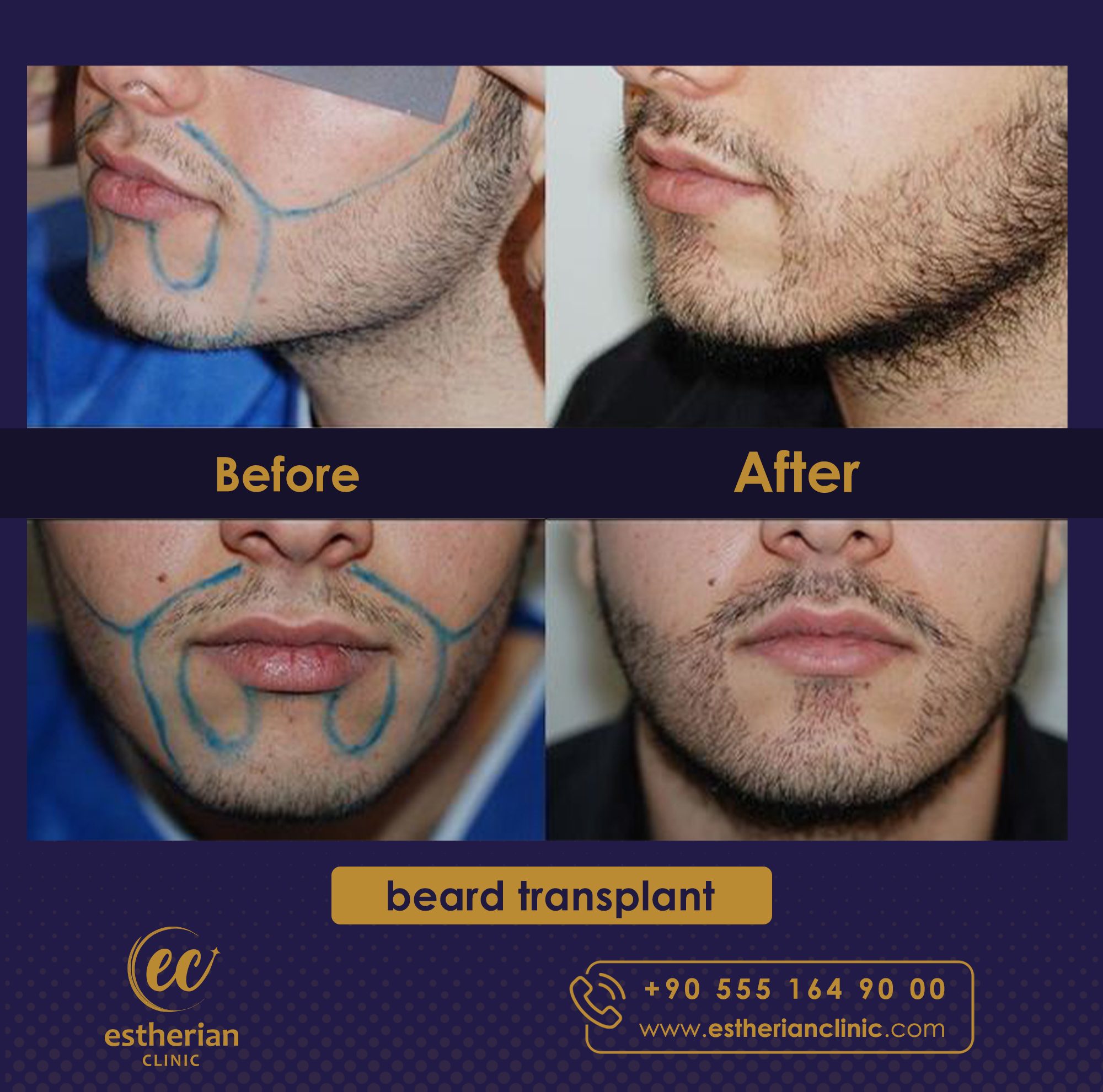Beard Transplant — Estherian clinic
