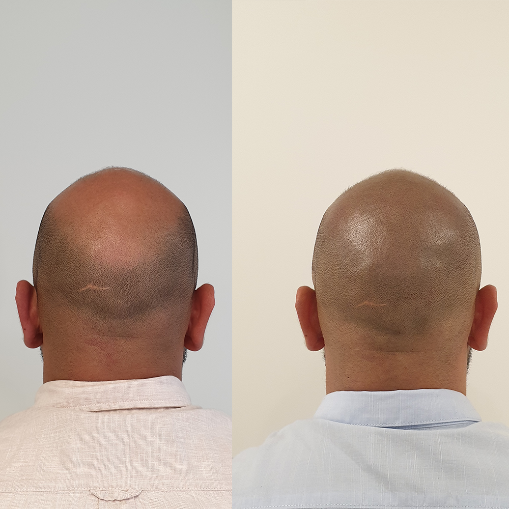 Scalp Micro Pigmentation SMP — Scalp Esthetik