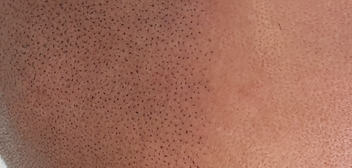 Scalp Micro Pigmentation SMP — Scalp Esthetik