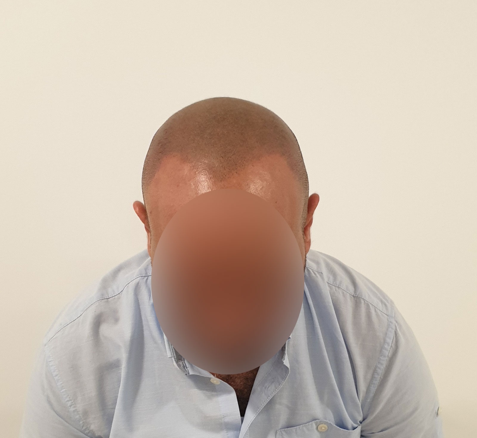 Scalp Micro Pigmentation SMP — Scalp Esthetik