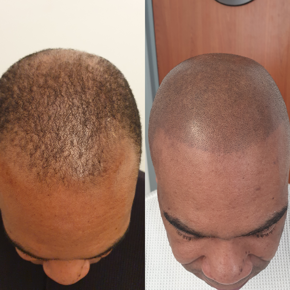 Scalp Micro Pigmentation SMP — Scalp Esthetik