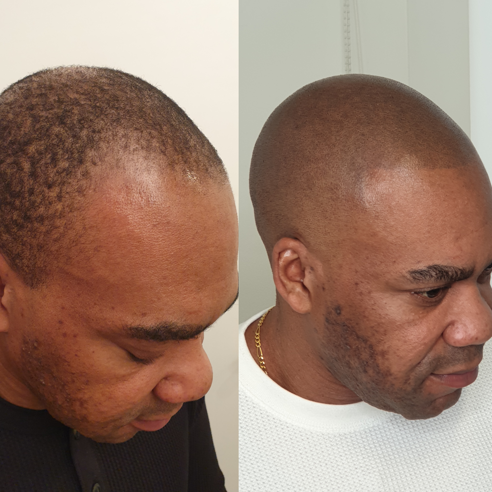 Scalp Micro Pigmentation SMP — Scalp Esthetik