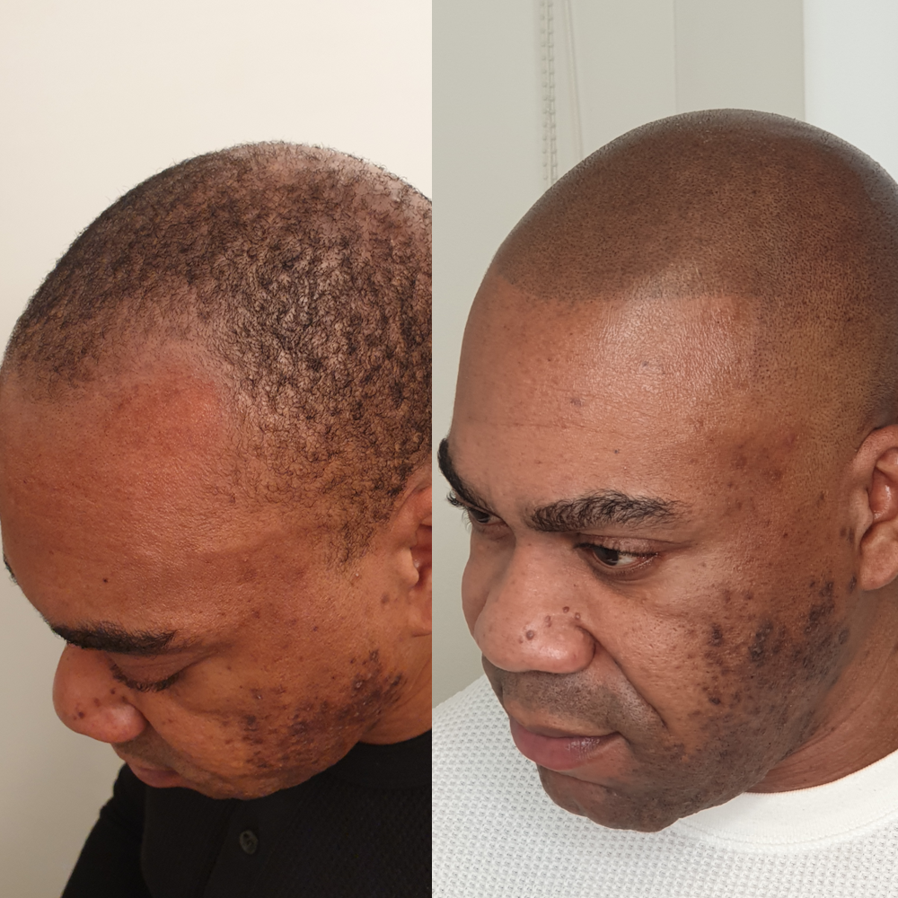 Scalp Micro Pigmentation SMP — Scalp Esthetik