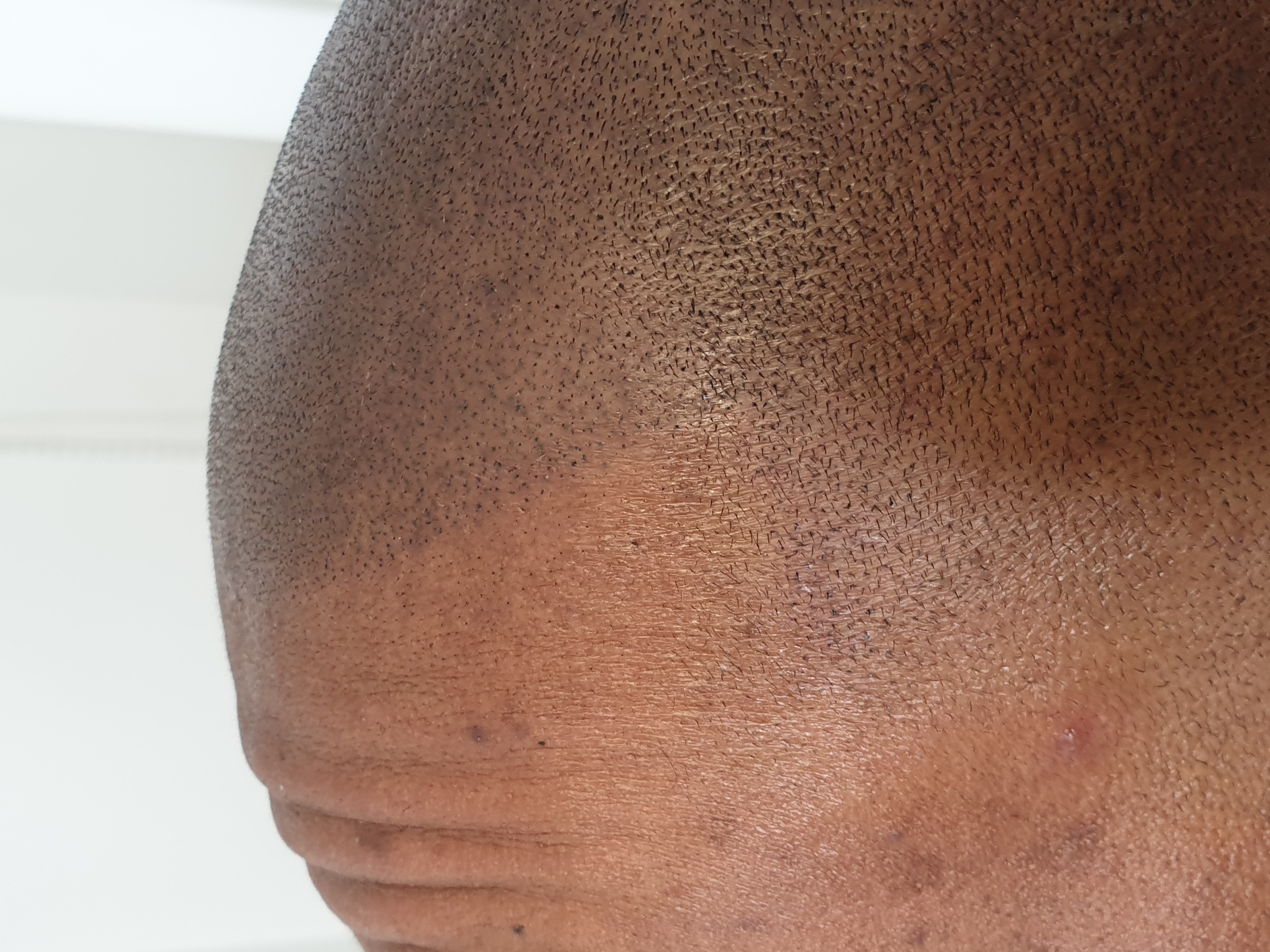Scalp Micro Pigmentation SMP — Scalp Esthetik