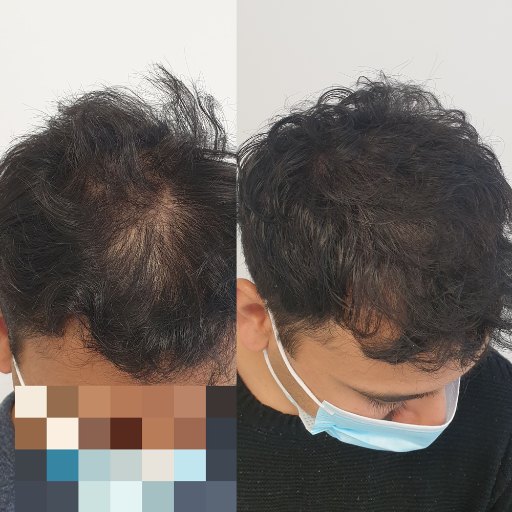 Scalp Micro Pigmentation SMP — Scalp Esthetik