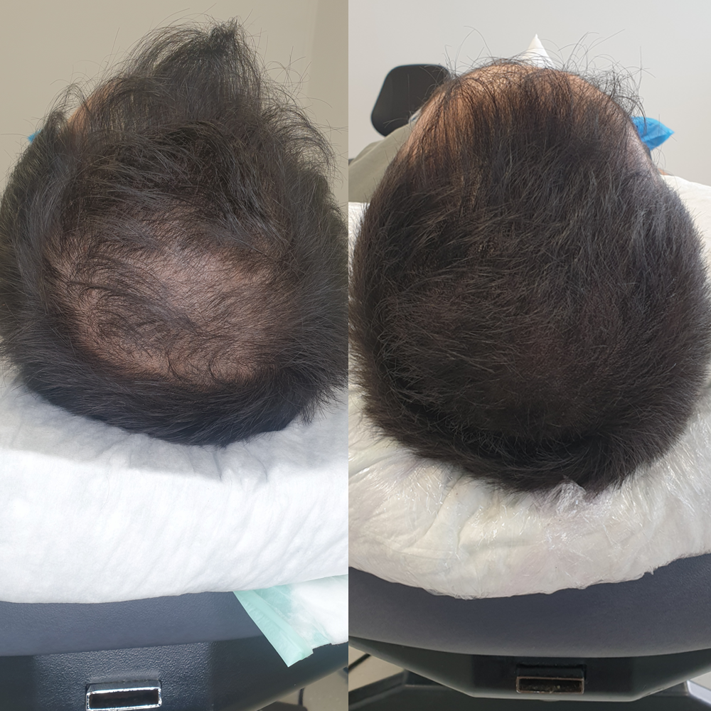 Scalp Micro Pigmentation SMP — Scalp Esthetik