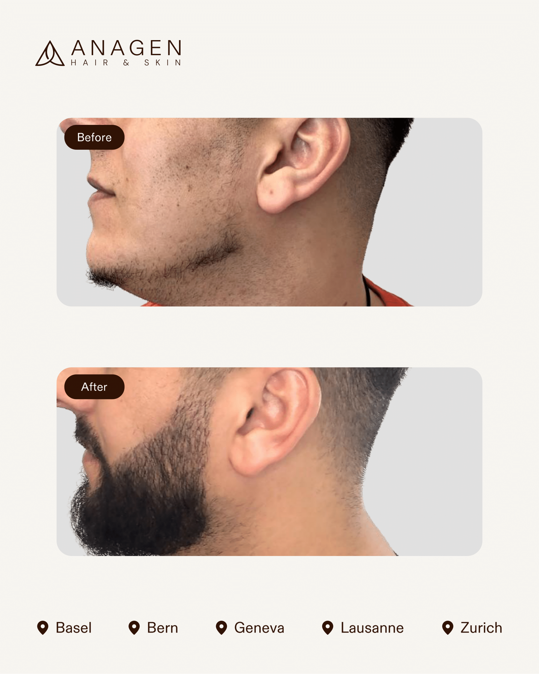 Beard Transplant — Anagen