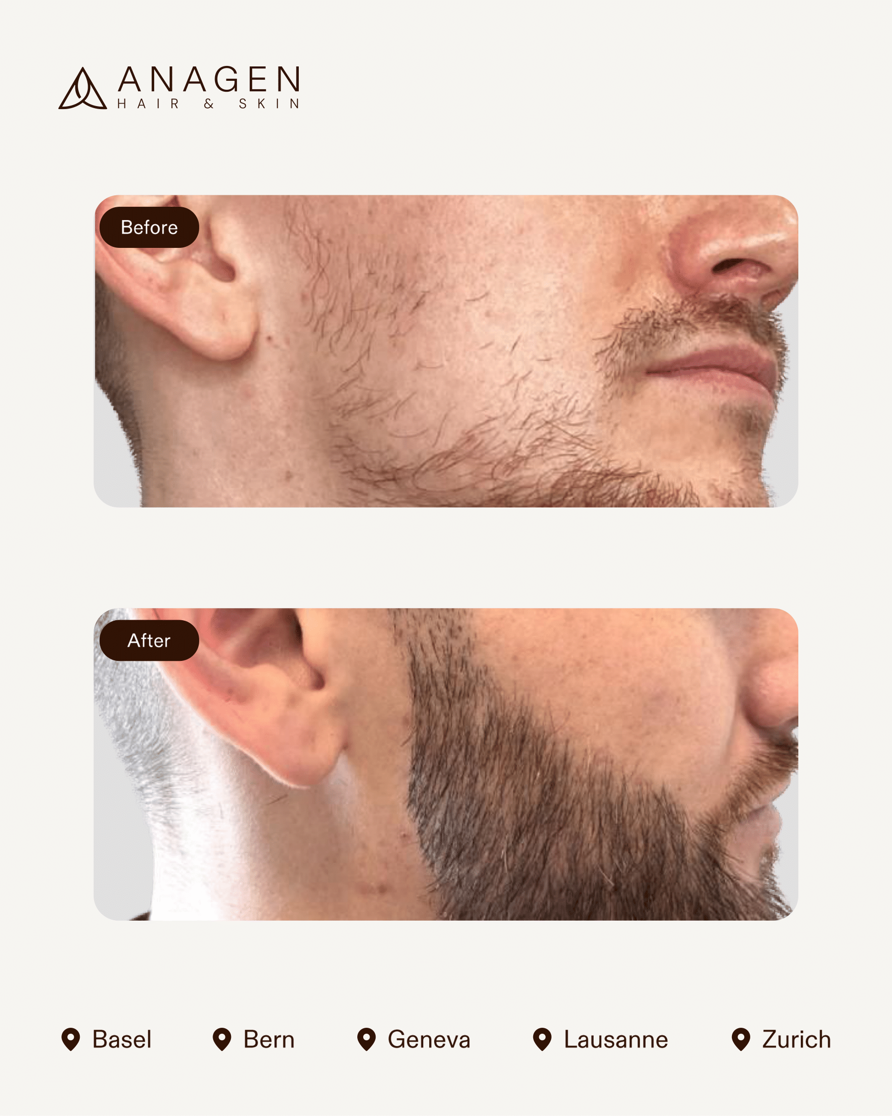 Beard Transplant — Anagen