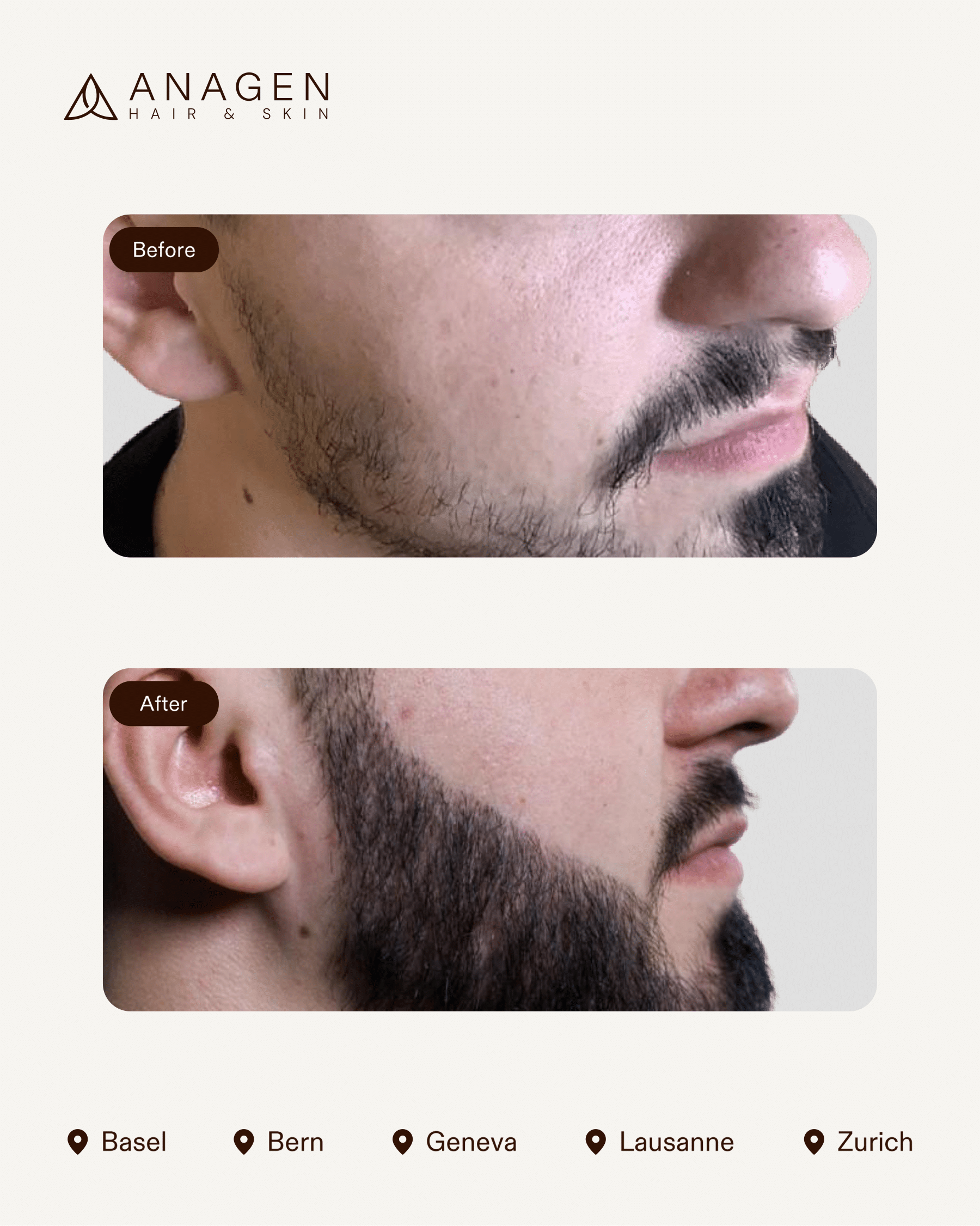 Beard Transplant — Anagen