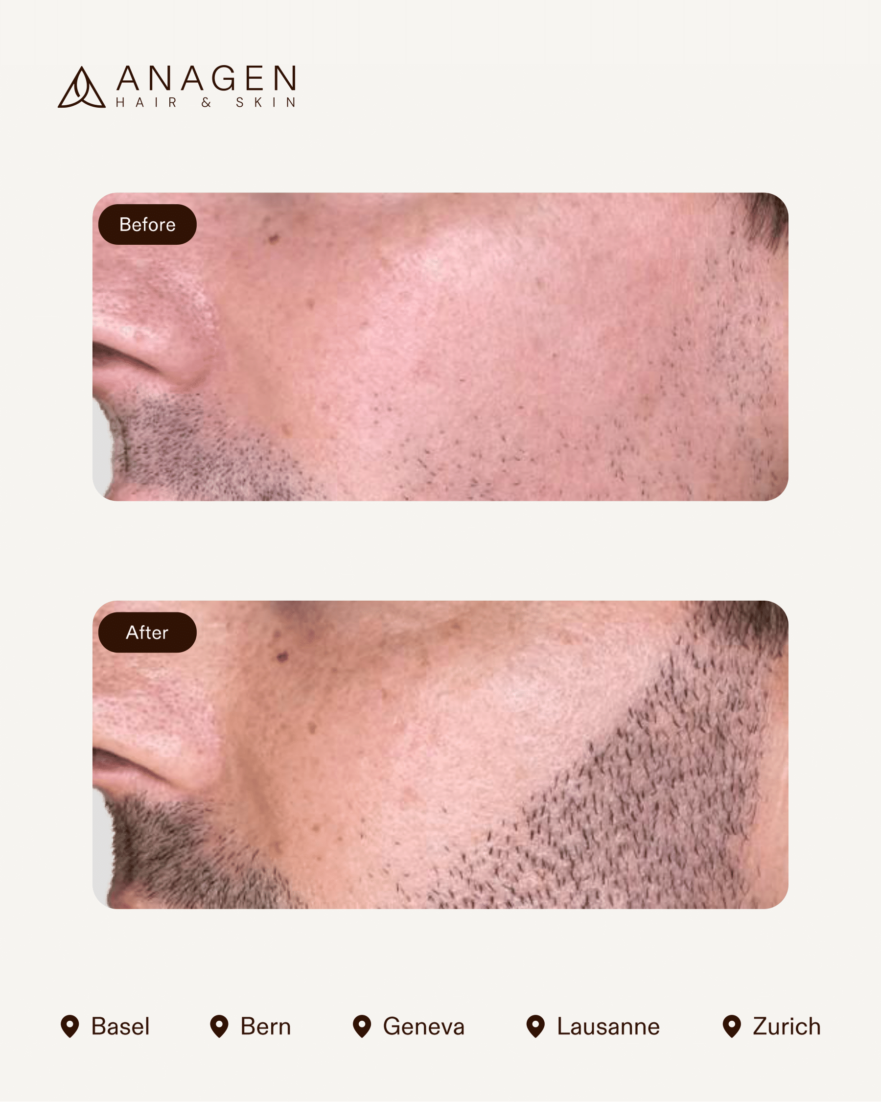 Beard Transplant — Anagen