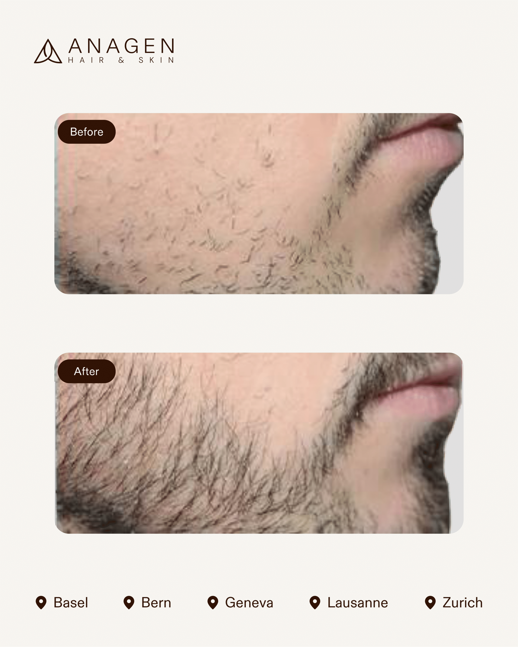 Beard Transplant — Anagen