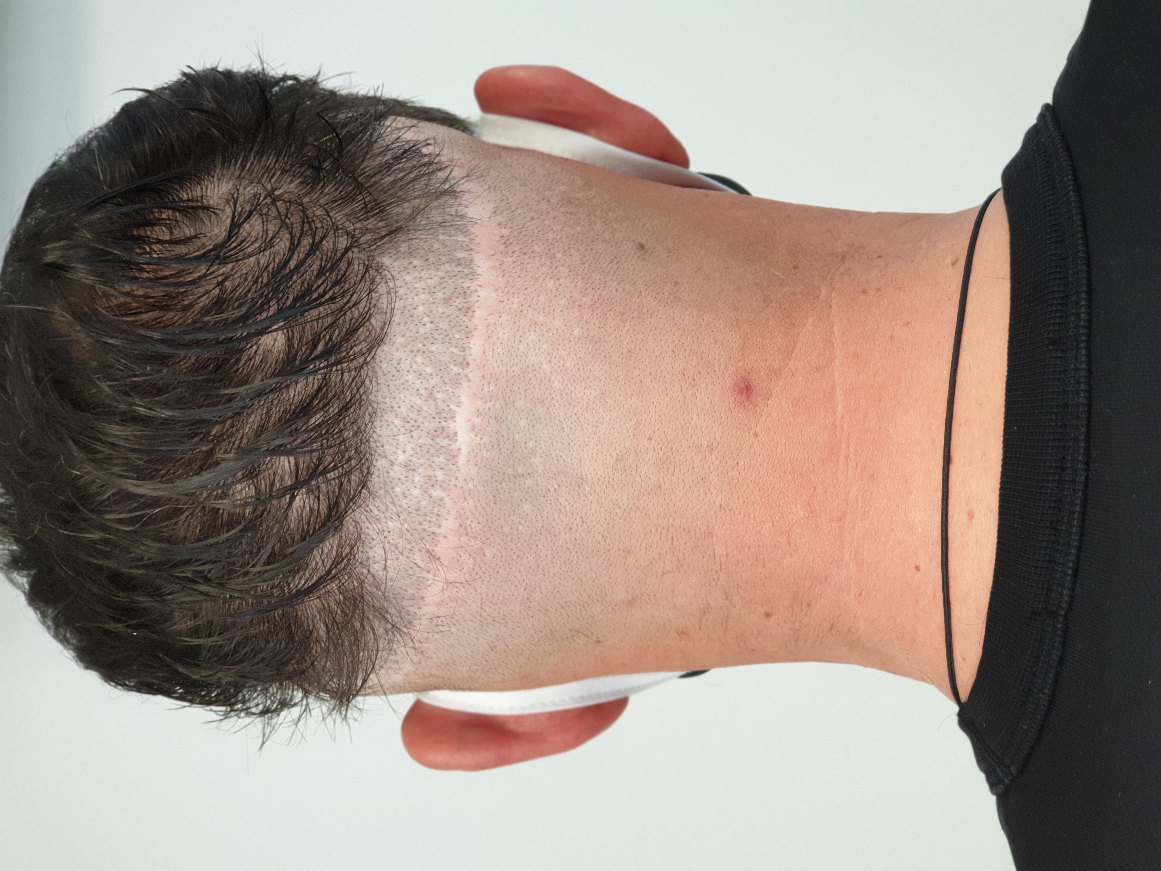 Scalp Micro Pigmentation SMP — Scalp Esthetik