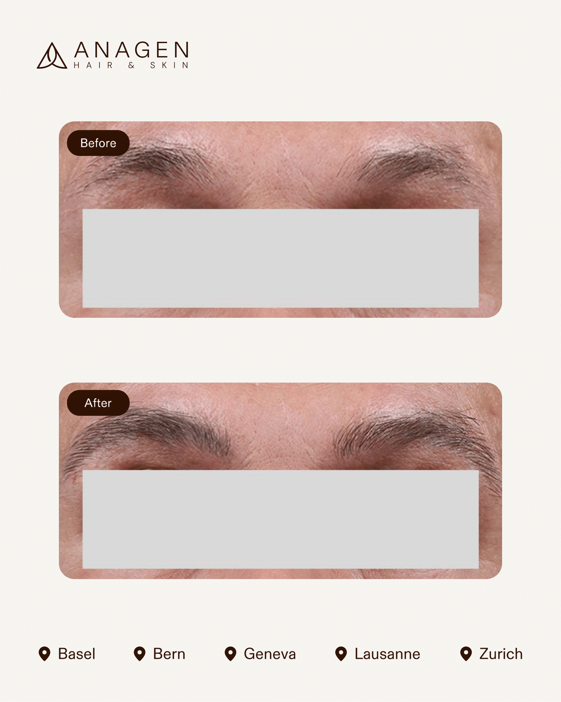 Eyebrow Transplant — Anagen
