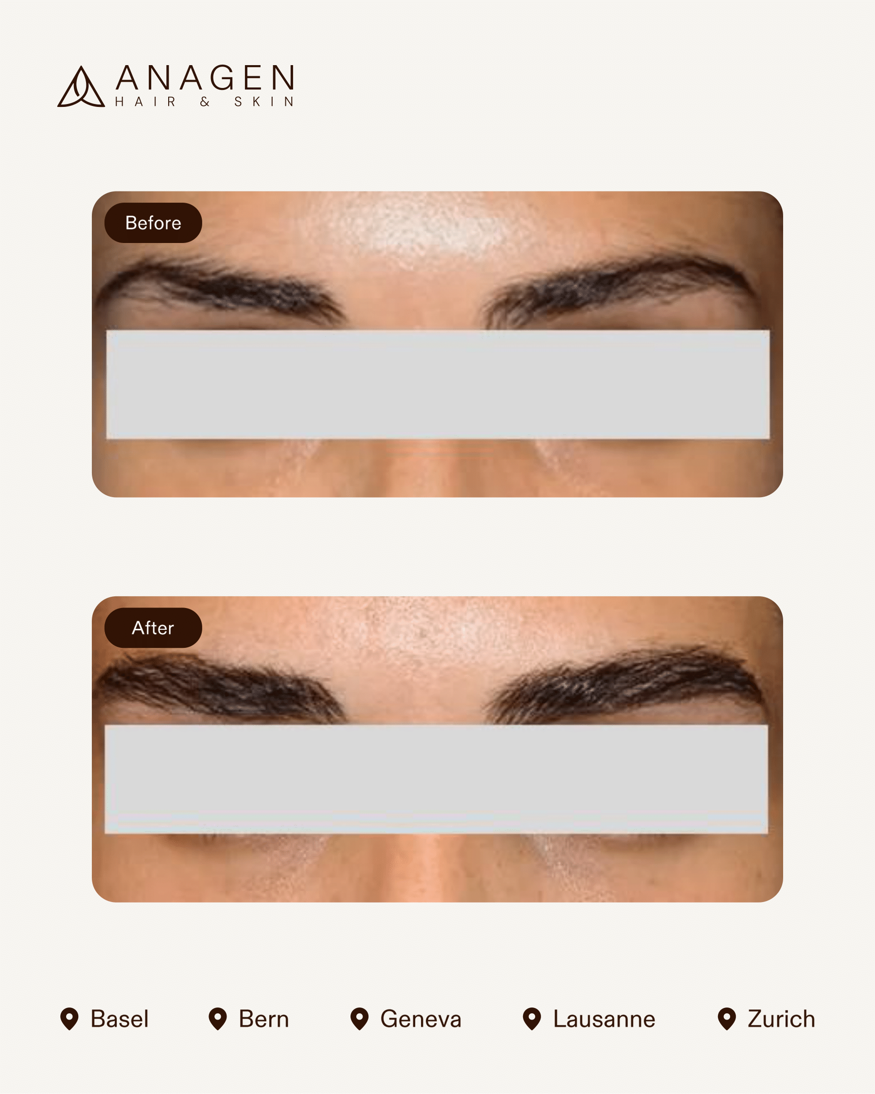 Eyebrow Transplant — Anagen