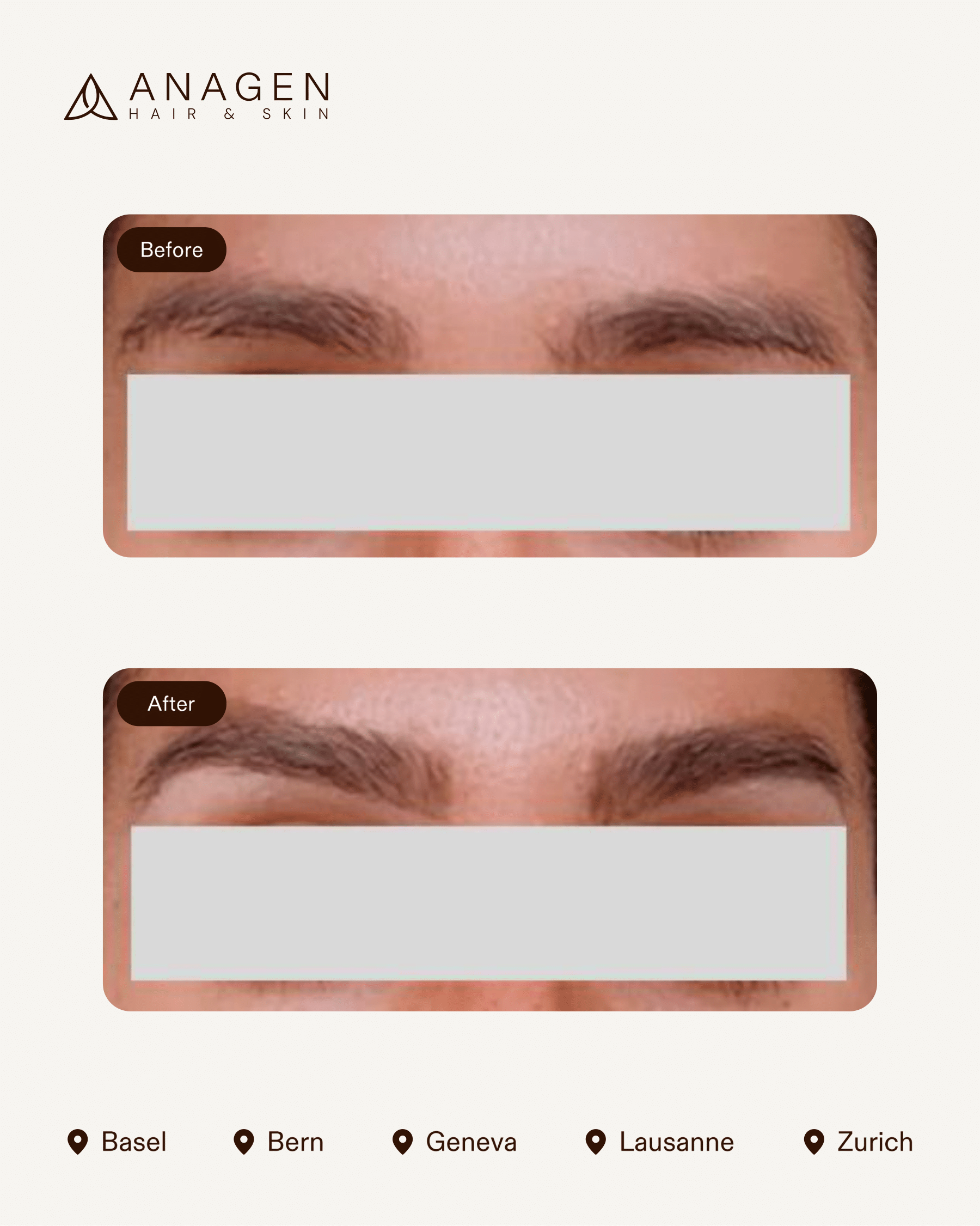 Eyebrow Transplant — Anagen