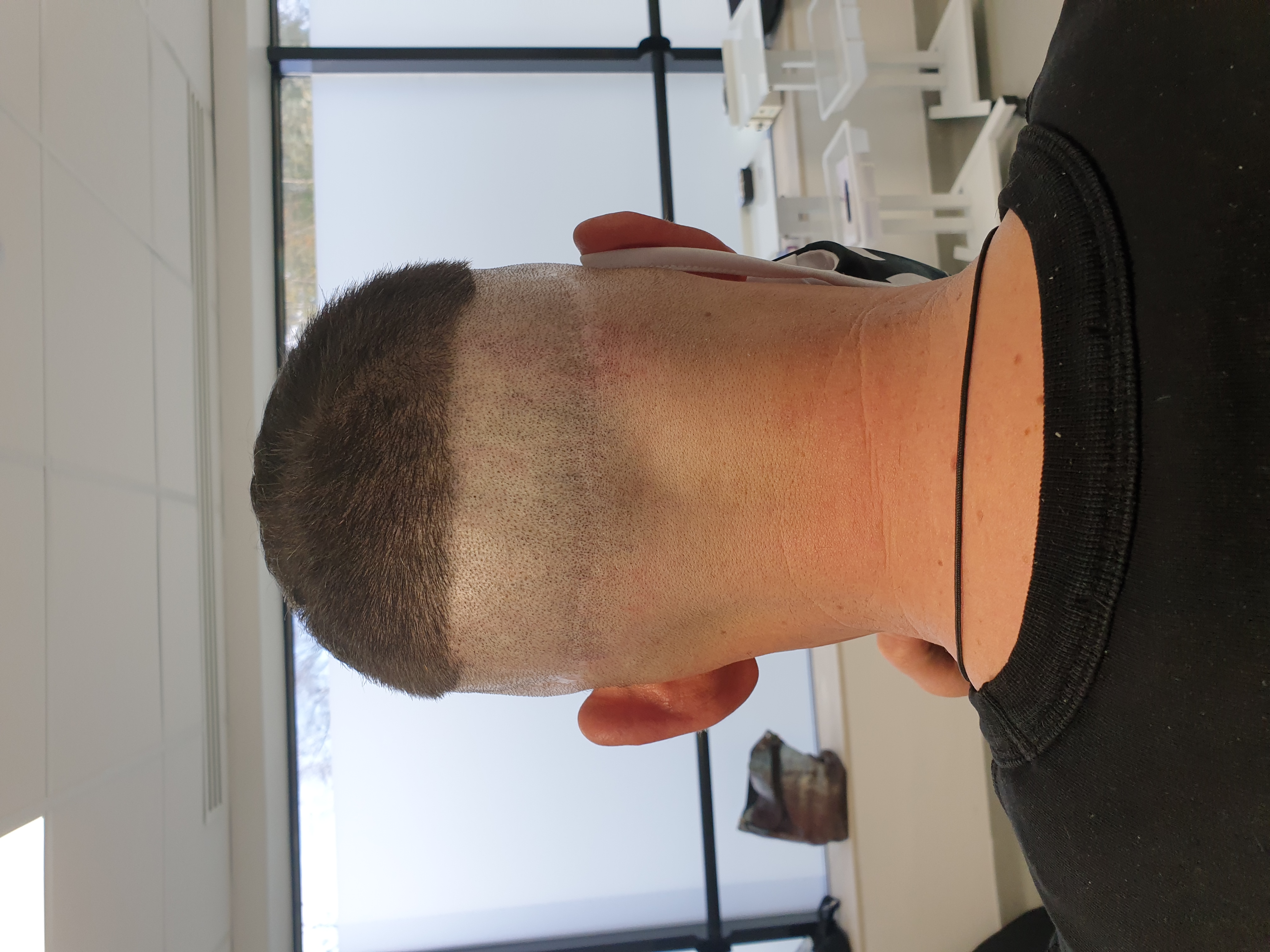 Scalp Micro Pigmentation SMP — Scalp Esthetik