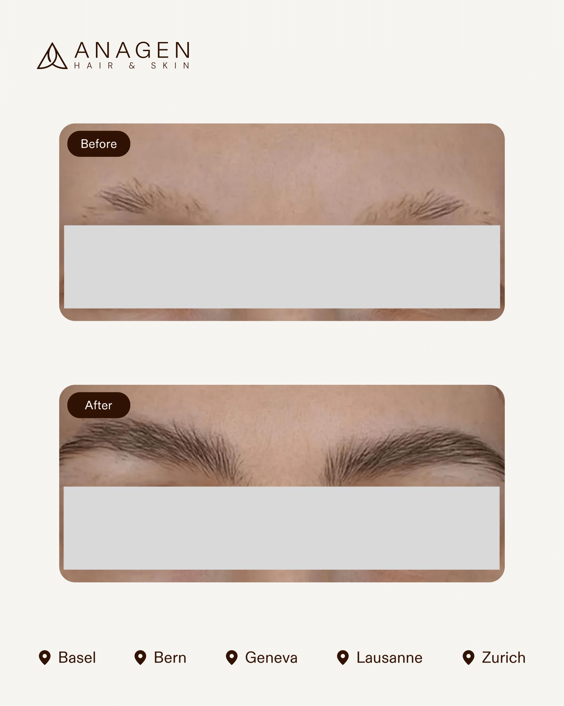 Eyebrow Transplant — Anagen