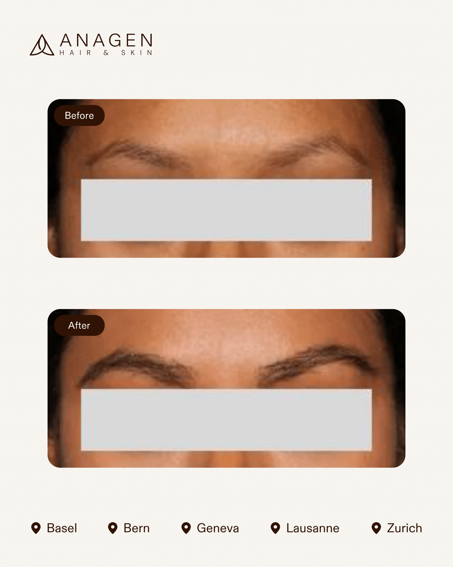 Eyebrow Transplant — Anagen
