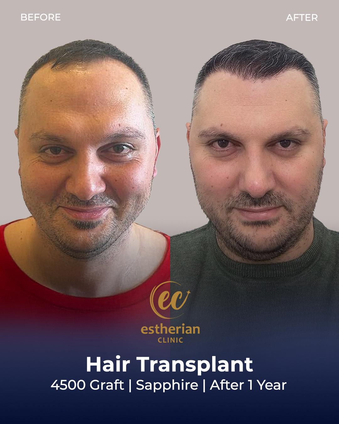 FUE — Estherian clinic
