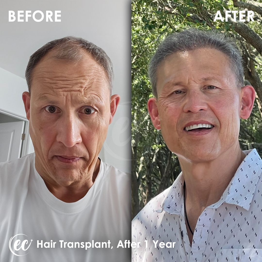 FUE — Estherian clinic