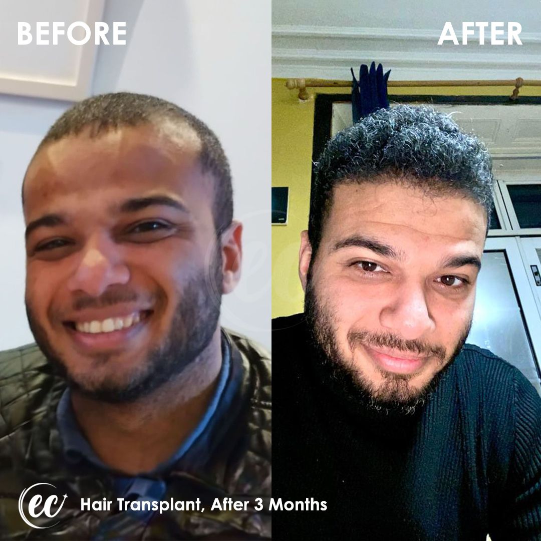 FUE — Estherian clinic