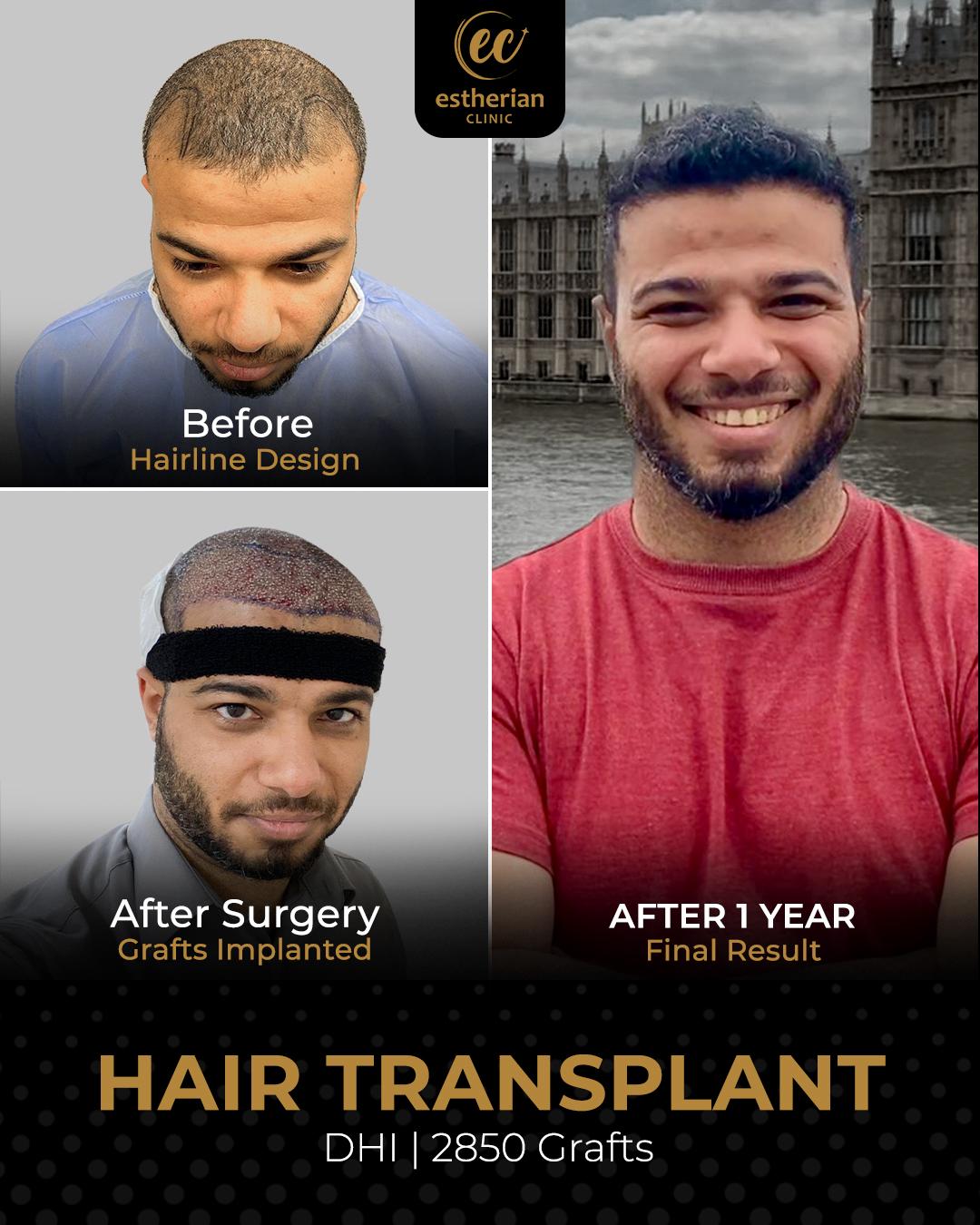 FUE — Estherian clinic