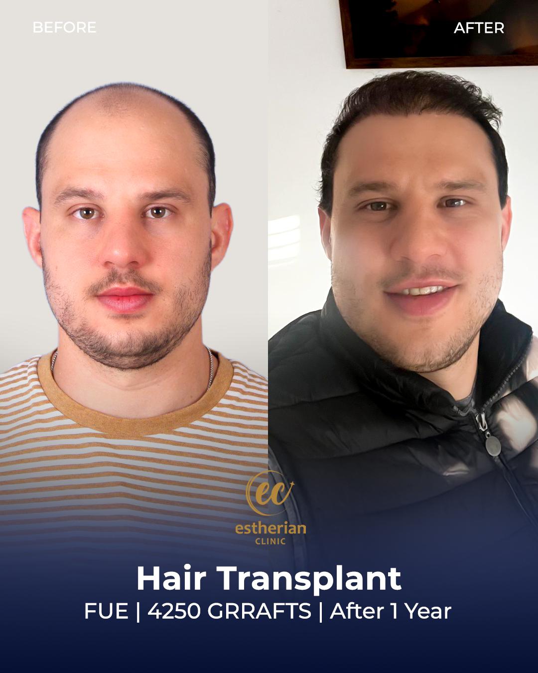 FUE — Estherian clinic