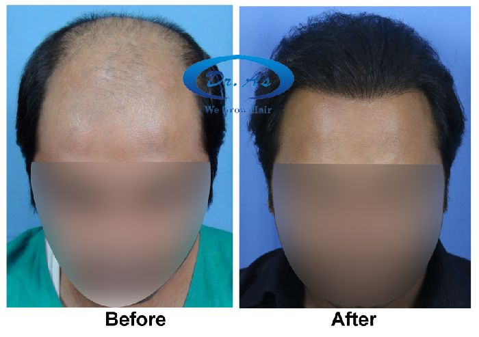 BHT Body Hair Transplant — Dr A's clinic - hair Transplant clinic
