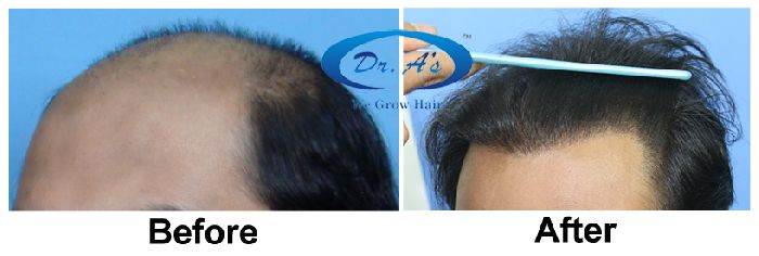 BHT Body Hair Transplant — Dr A's clinic - hair Transplant clinic