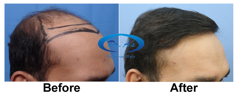 BHT Body Hair Transplant — Dr A's clinic - hair Transplant clinic