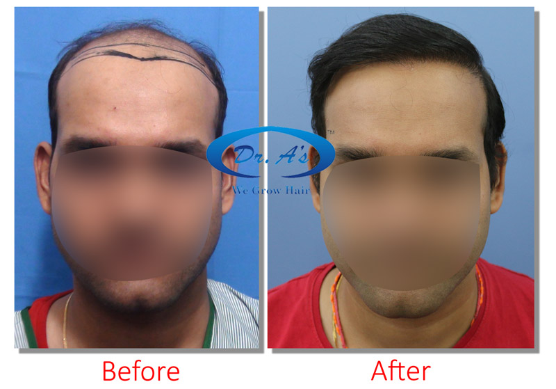BHT Body Hair Transplant — Dr A's clinic - hair Transplant clinic