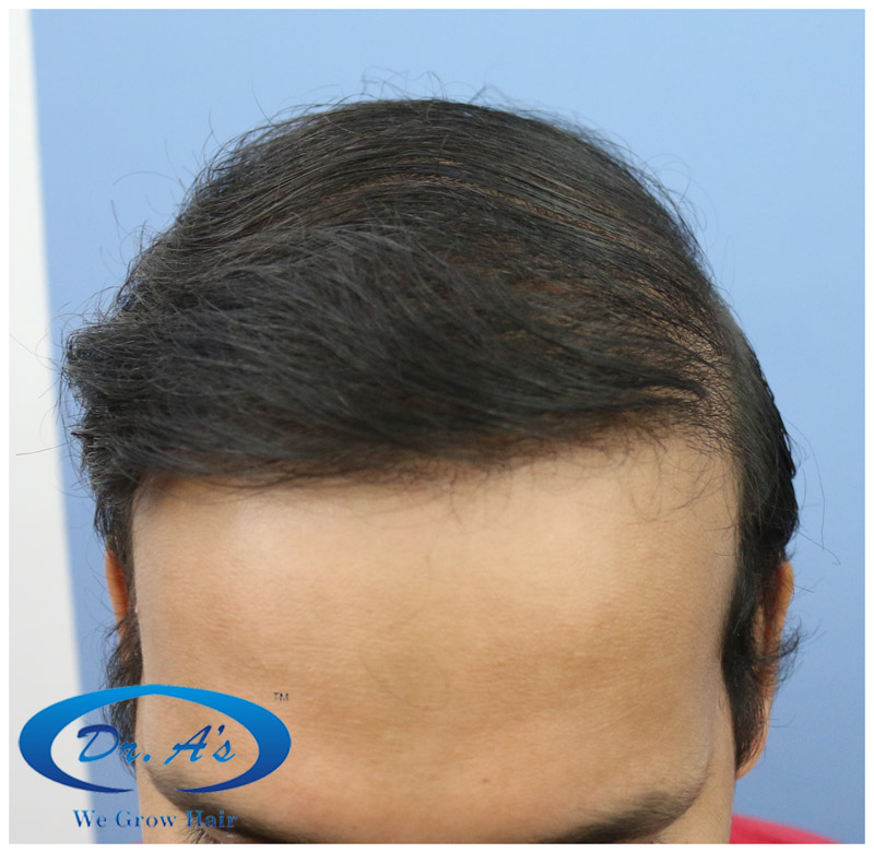 BHT Body Hair Transplant — Dr A's clinic - hair Transplant clinic