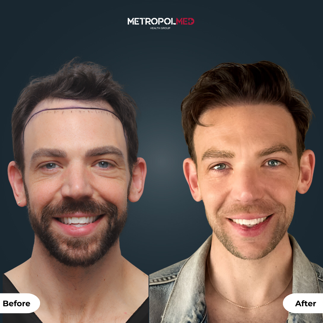 FUE — MetropolMed