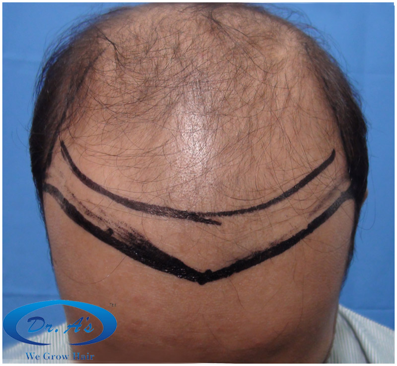BHT Body Hair Transplant — Dr A's clinic - hair Transplant clinic