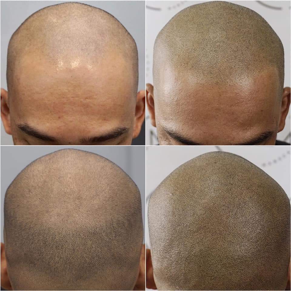 Scalp Micro Pigmentation SMP — Scalp Esthetik