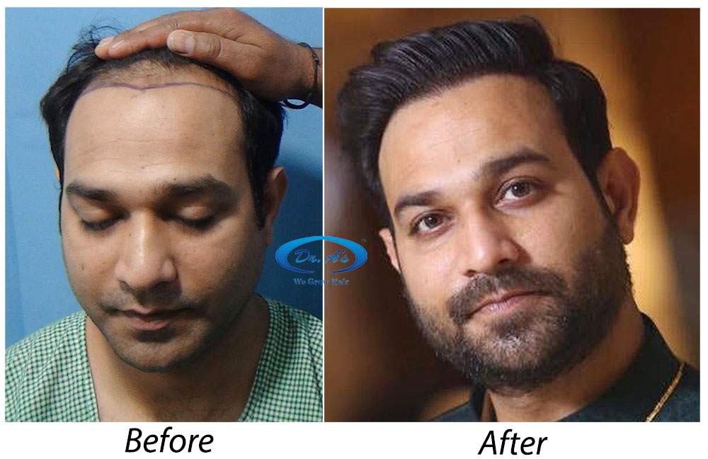 BHT Body Hair Transplant — Dr A's clinic - hair Transplant clinic