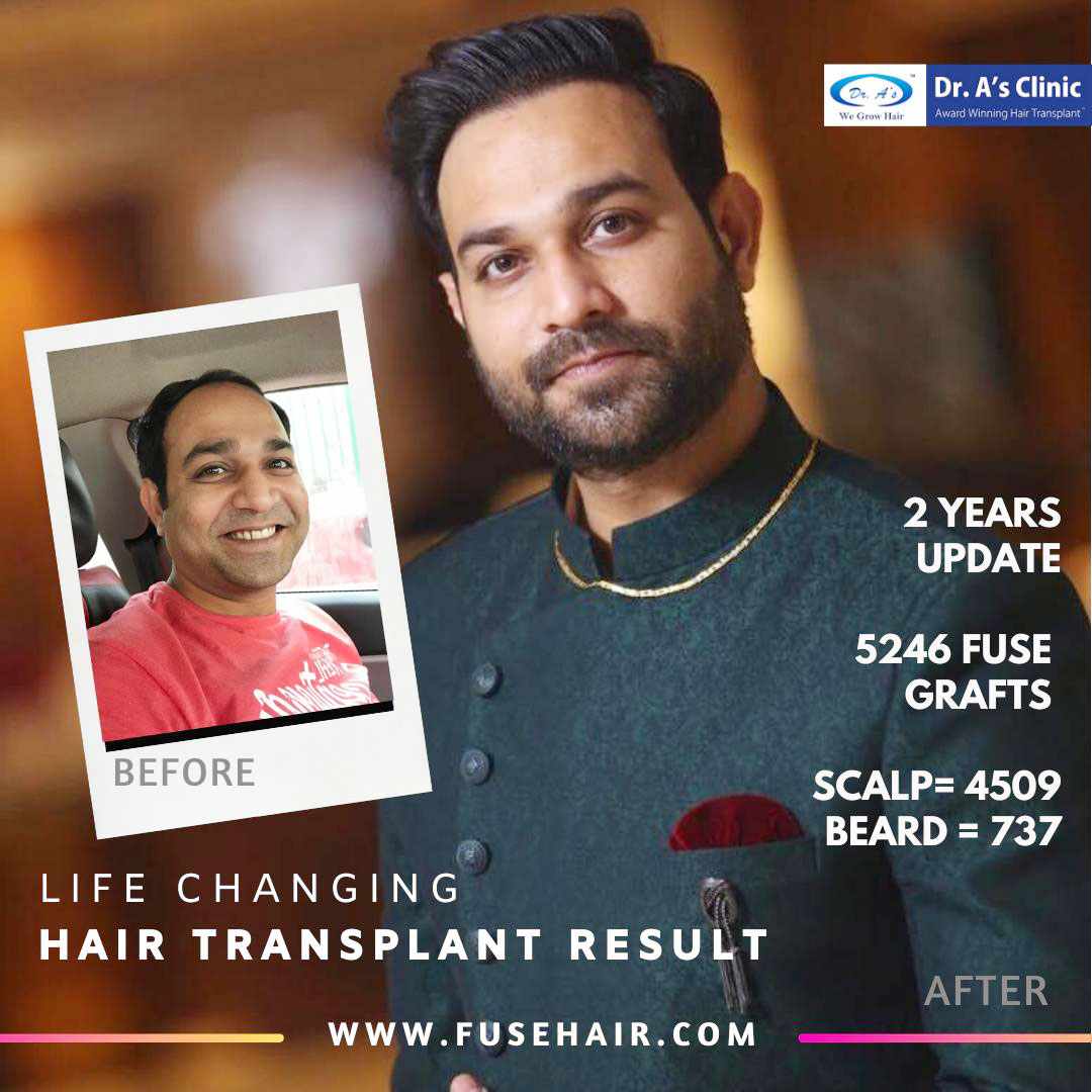 BHT Body Hair Transplant — Dr A's clinic - hair Transplant clinic