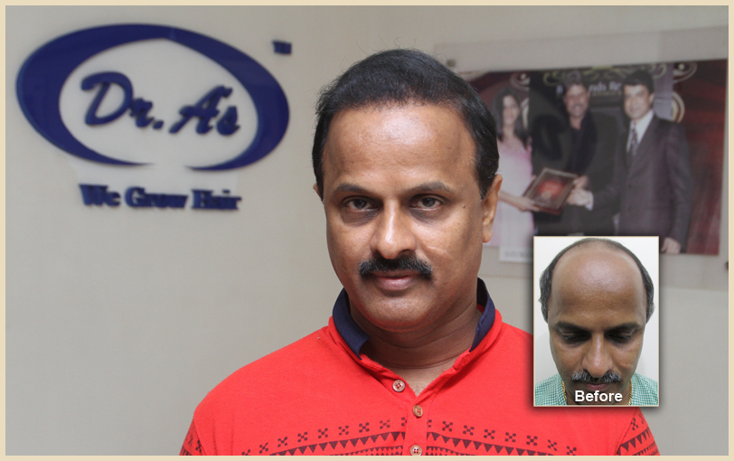 BHT Body Hair Transplant — Dr A's clinic - hair Transplant clinic