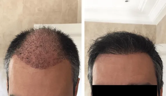FUE Sapphire — CARTHAGO MED