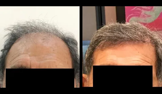 FUE Sapphire — CARTHAGO MED